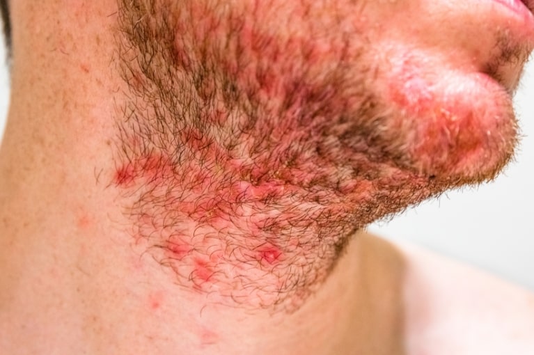 Muž so seboroickou dermatitídou v oblasti brady