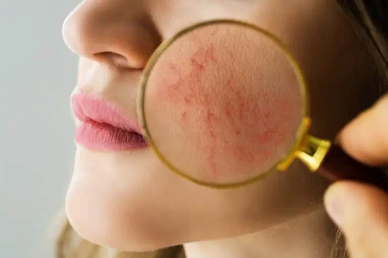 Rosacea: Ako ju rozpoznať a zvládnuť?